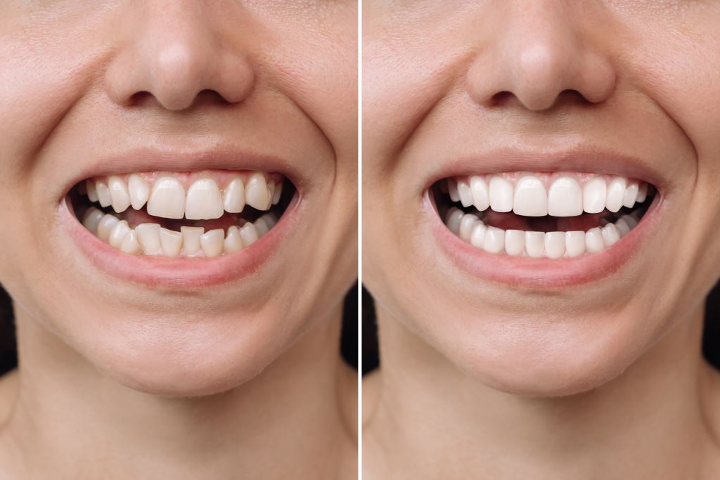 Qual é a forma mais eficaz de alinhar os Dentes? Confira as dicas - Blog -  OrthoDontic Sorria Sempre